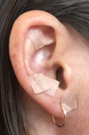 Ear accupucture